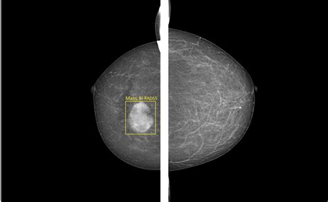 the villages digital mammography|Effect of Digital Mammography for Breast Cancer Screening: A.